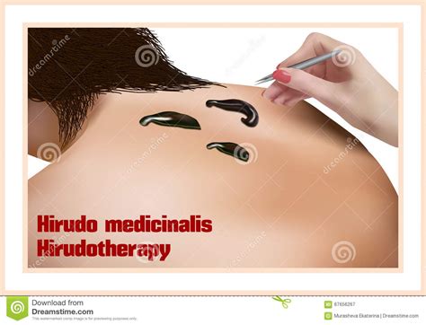 Hirudotherapy. Treatment with Leeches Stock Vector - Illustration of ...