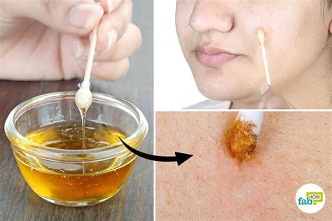 Honey for Acne: Top 10 Remedies and Masks | Fab How