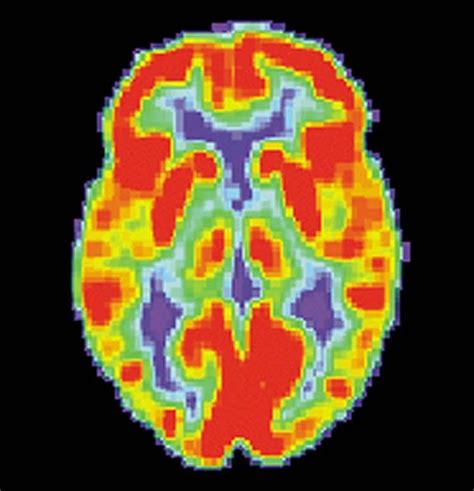 brain PET scan PTSD - Neuroscience News