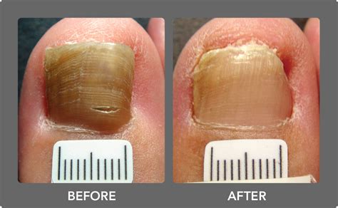 Toenail Fungus Laser Treatment | Boca Raton Podiatrist