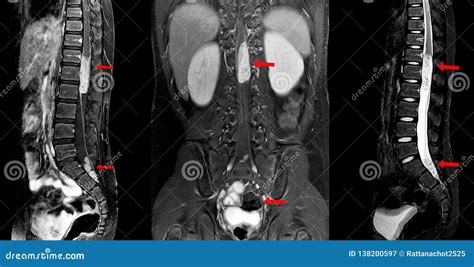 MRI Spine Showing Mass At Distal Cord And Conus Medullaris, With Tumor Seedings At Lower Spinal ...