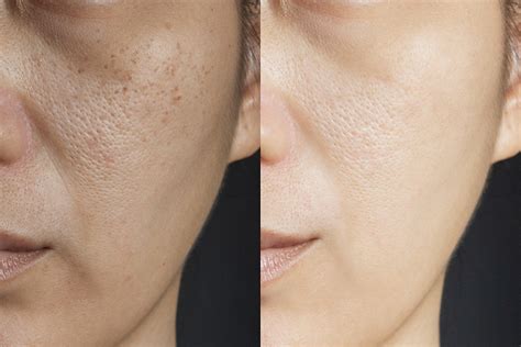 The Deal About Enlarged Pores: Causes & Treatment Options