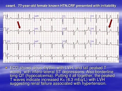 Ecg Changes With Hypocalcemia