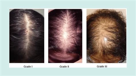 How to Treat Androgenic Alopecia in Females