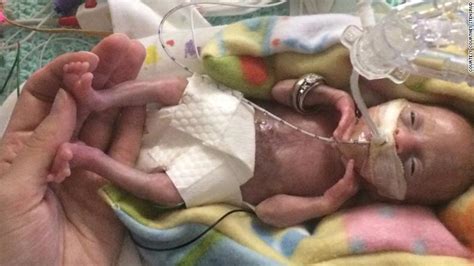 Miracle: Born at 21 weeks, 'most premature' baby is thriving