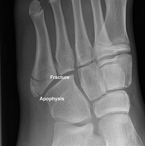 Fifth Metatarsal Fracture Treatment And Tips / Metatarsal Fractures Orthopaedia : This chapter ...