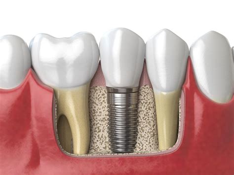 Cost of Dental Implants Indianapolis IN | DentalSpa Indy