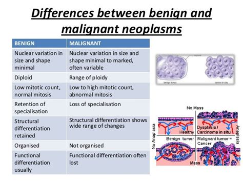 Neoplasia Characteristics and classification of cancer