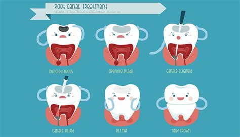 Why am I experiencing pain after root canal treatment?