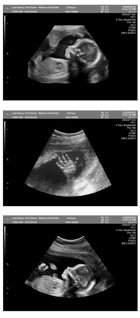 22 Weeks Ultrasound - Ultrasounds