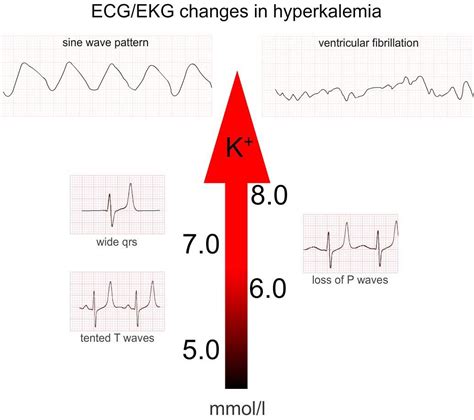 Hyperkalemia | Hyperkalemia, Emergency medical