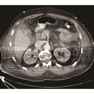 CT scan of abdomen and pelvic showing hemoperitoneum and mass-like... | Download Scientific Diagram