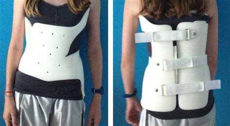 SCOLIOSIS BRACE SYSTEM - K.K. Prosthetic & Orthopaedic Equipment