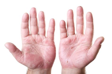 Hand Eczema: Causes, Symptoms and Treatment Options