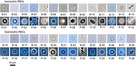 Isomorphic red blood cells (RBCs) and dysmorphic RBCs, 400×. B: bright... | Download Scientific ...