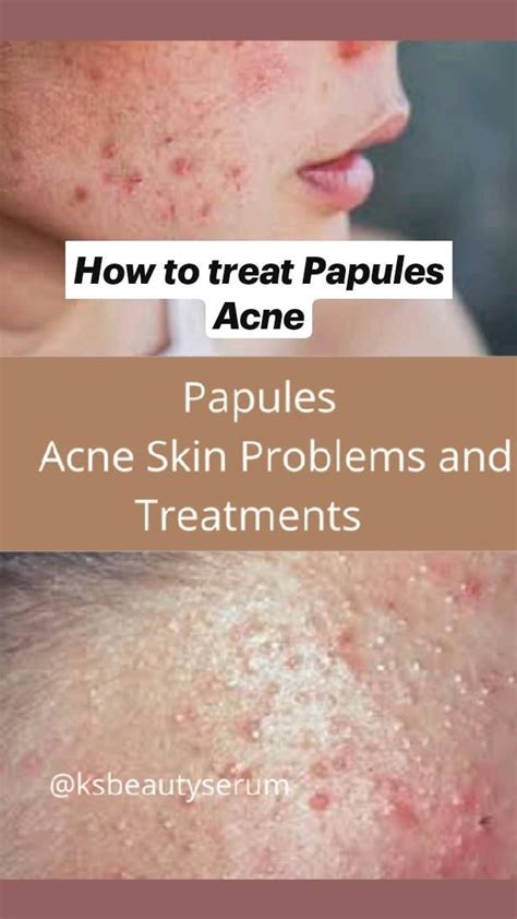 How to treat Papules Acne... in 2022 | Papules acne, Organic skin care, Acne treatments & kits