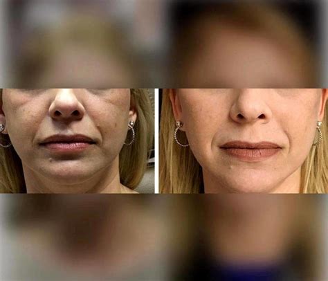 Mid-face Lift Before And After Pictures » Facelift: Info, Prices, Photos, Reviews, Q&A