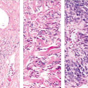 4 Hamartoma. Histology showing respiratory epithelium lined by... | Download Scientific Diagram