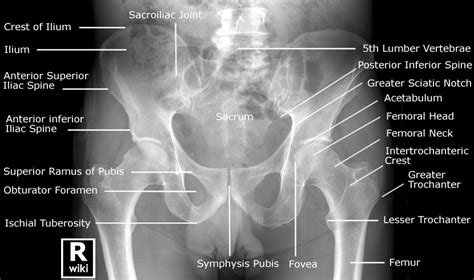 Ap Pelvis X Ray Labeled