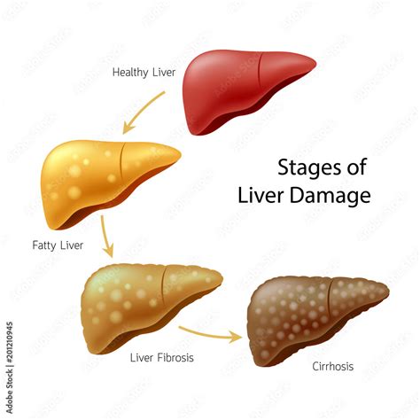 Stages of liver damage. Liver Disease. Healthy, fatty, fibrosis and Cirrhosis. Illustration info ...