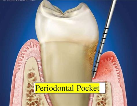 periodontal pocket