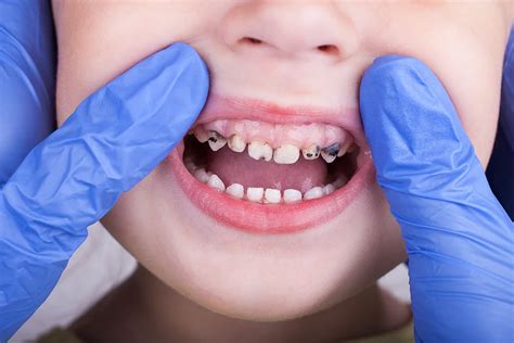 Bad Teeth Kids: Common Dental Problems in Children - healthlinee