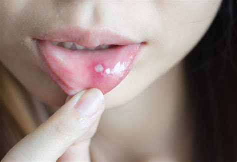 What is the difference between cold sores and mouth ulcers? | News ...