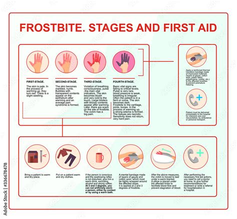 Frostbite - symptoms, protection and treatment. infographics illustration in vector. First aid ...