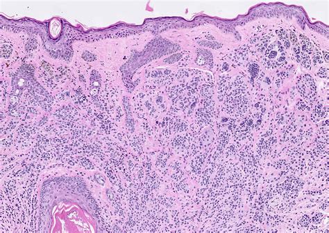 Congenital Nevus Histology