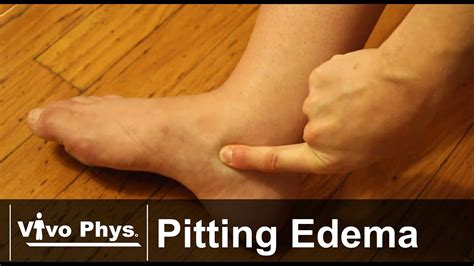 Lower Extremity Pitting Edema