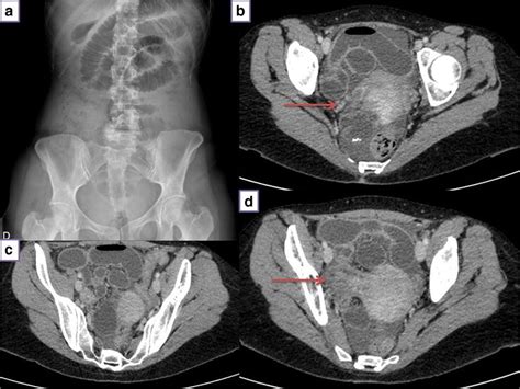 Radiological findings of the hernia of broad ligament | Download ...