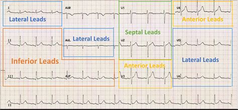 ECG Interpretation