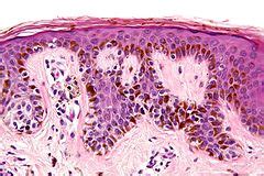 Dysplastic nevus - Libre Pathology