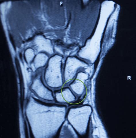 Wrist Ligament Ultrasound