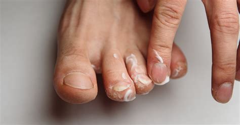 Best Ways to Prevent (and Treat) Athlete's Foot Fungus at Home - This Dad Does