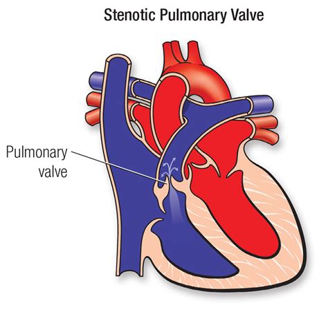 Pulmonary Valve Stenosis | American Heart Association