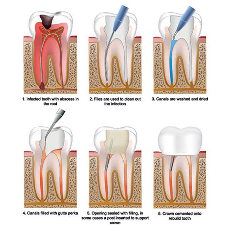 Root Canal Specialist near you | Root canal from $699