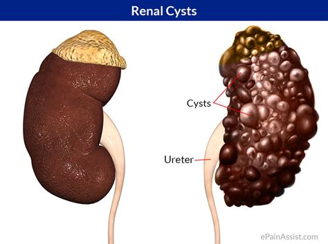 treatment for kidney disease: A Complex Cyst on Kidney May Rupture if It Is too Large