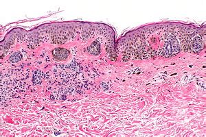 Compound nevus - Libre Pathology