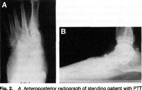 Talipes Calcaneovalgus | Semantic Scholar