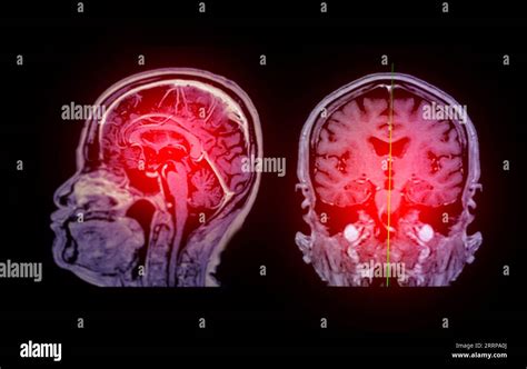 MRI brain scan Sagittal and coronal view with reference line for detect Brain diseases sush as ...