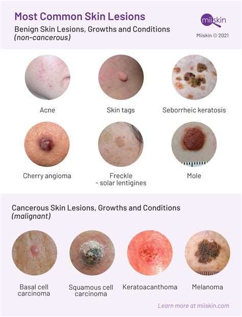 Tumor Skin Lesion