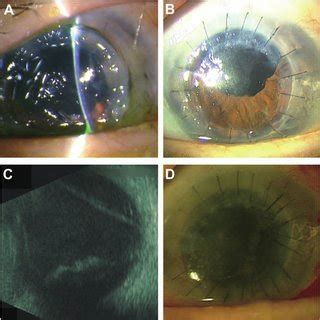 A 67-year-old man experienced repeated globe ruptures; the first rupture | Download Scientific ...