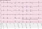 Sinoatrial Block (Blocks Sinoatrial): Symptoms, Diagnosis and Treatment ...