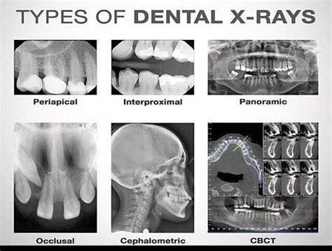 Periapical X Ray