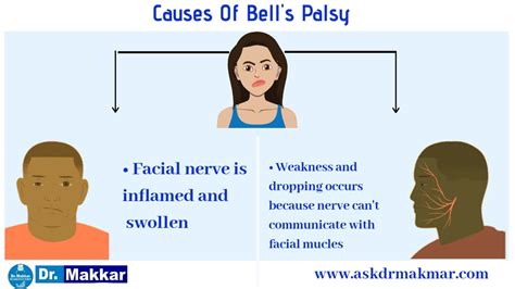 Facial palsy causes – Telegraph