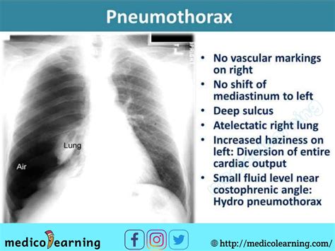 chest x ray interpretation - Wendy Rutherford