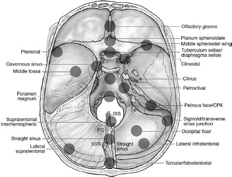 Falx Meningioma