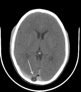 Giant Arachnoid granulation - Sumer's Radiology Blog