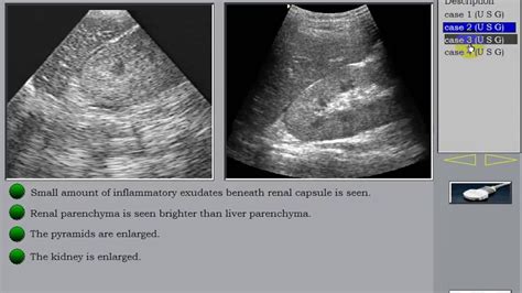 Ultrasound of the kidney 3 Inflammatory kidney disesaes Pyelonephritis TB - YouTube